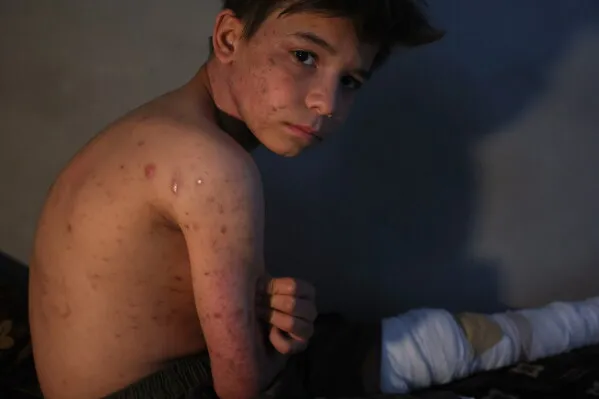 طفل سوري مصاب بجروح في جسده، يجلس على سرير مع ضمادات على ساقه، يعكس معاناة الأطفال بسبب الألغام في سوريا.