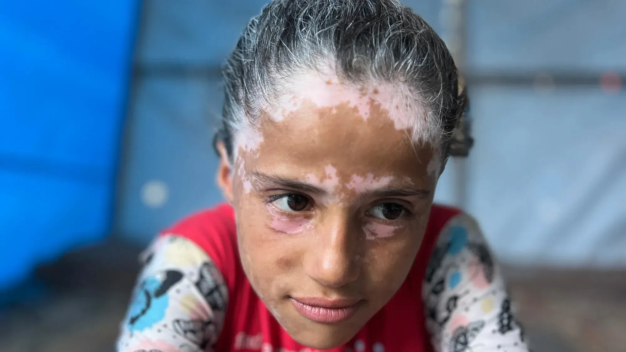 لانا الشريف، فتاة فلسطينية، تظهر بشعر رمادي وبقع بيضاء على جلدها نتيجة البهاق الناتج عن صدمة نفسية بسبب الحرب في غزة.