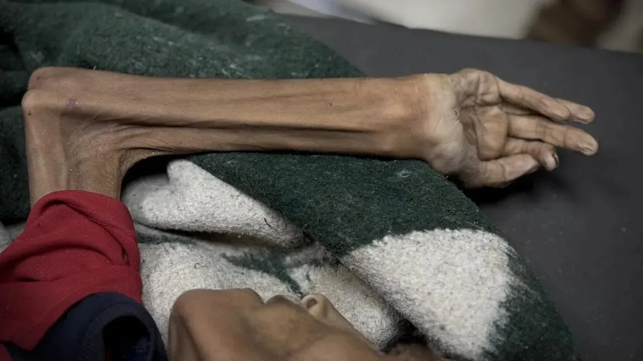 ذراع نحيل لشخص يعاني من سوء التغذية، مغطاة ببطانية، تعكس معاناة الفلسطينيين في قطاع غزة وسط أزمة إنسانية خانقة.