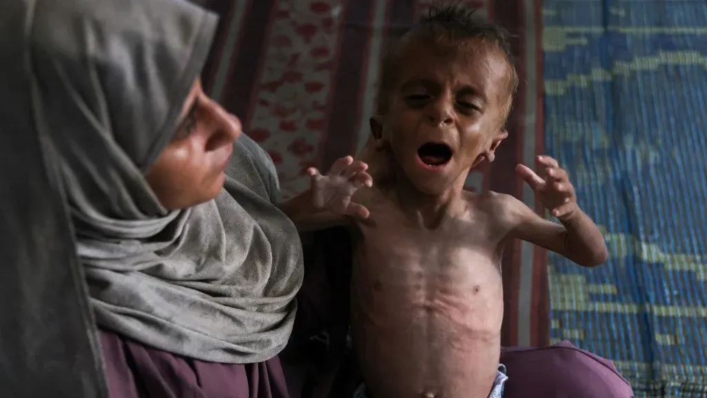 طفل يعاني من سوء تغذية حاد في غزة، يجلس في حضن امرأة ترتدي حجاباً، يعكس أزمة الجوع وتأثير الحصار الإسرائيلي على المدنيين.