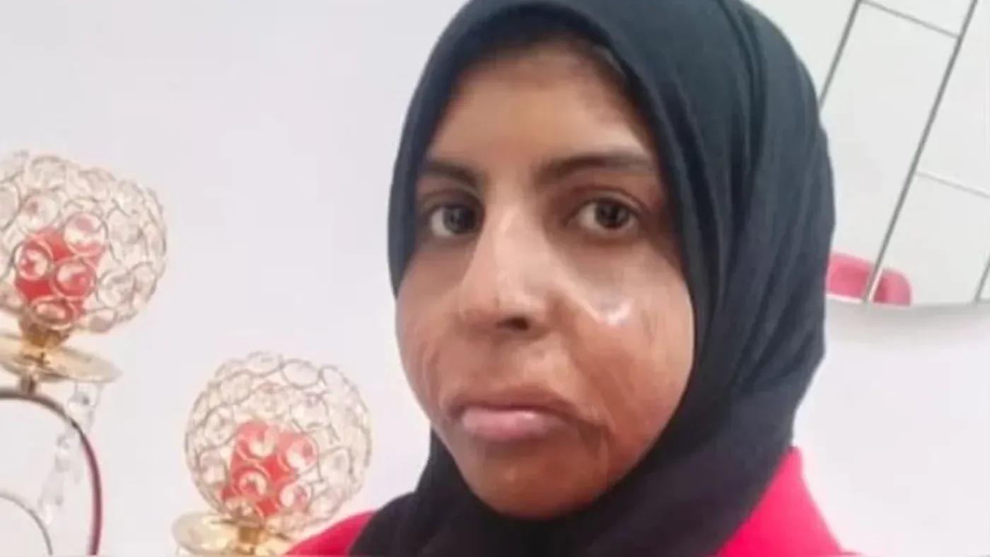 امرأة هندية ترتدي حجابًا، تظهر آثار حروق على وجهها، في خلفية بسيطة. تعكس الصورة معاناتها وظروفها الصعبة بعد إدانتها.