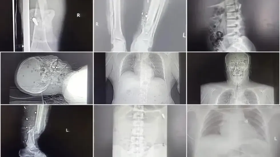 صور أشعة سينية تظهر إصابات متعددة لمتظاهرين جرحى، تعكس تأثير العنف خلال الاحتجاجات في إيران.