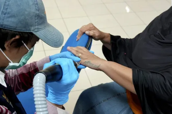امرأة تتلقى علاج إزالة الوشم بالليزر على يدها في مركز طبي بجاكرتا، ضمن برنامج خيري لمساعدة المسلمين على التوبة خلال رمضان.